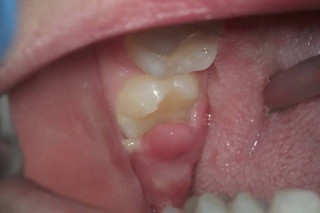 what's this sore gum on wisdom tooth - pericoronitis