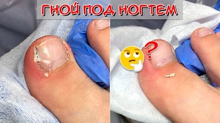 Гной под ногтем  Вросший ноготь на ноге