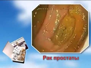 Кишечник до и после программы Коло   Вада Плюс