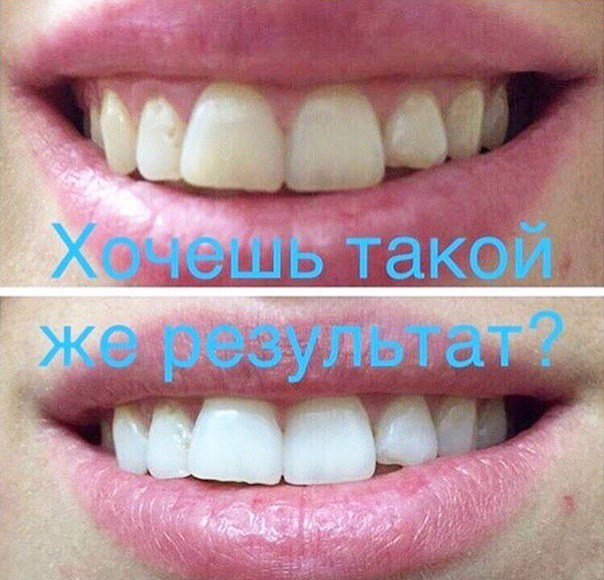 После отбеливания зубов что нельзя делать после После отбеливания зубов что нельзя делать после будесонид ингалятор карманный купить в волгограде