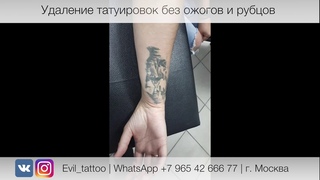 5 Лазерное удаление татуировки в студии Evil Tattoo. Без травм, ожогов и рубцов.