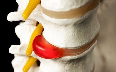 Грыжа позвоночника. Междисковая грыжа позвоночника. Bulging disc позвоночника. Межпозвоночная грыжа фото. Междисковая грыжа позвоночника.